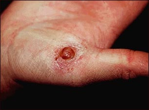 Granuloma piogénico en la mano