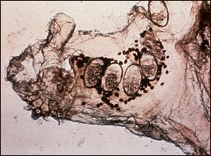 Microfotografía del ácaro de la escabiosis, los huevos y el ácaro en las heces