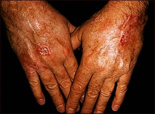 Cáncer de piel, escamocelular en las manos