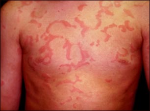 Ronchas (urticaria) en el pecho