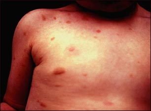 Urticaria pigmentosa en el tórax
