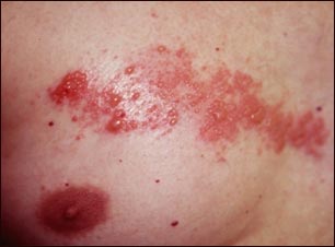 Herpes zoster (culebrilla) en el tórax