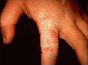 Dermatofitosis o tiña de la mano en el dedo