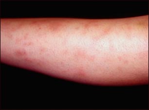 Eritema nodoso asociado con sarcoidosis