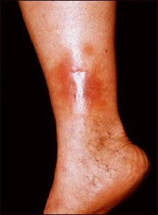 Dermatitis por estasis en la pierna
