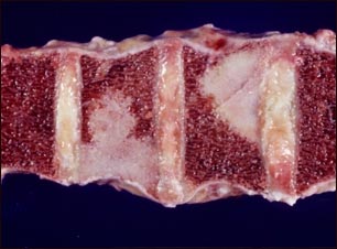 Tumor de la espina dorsal