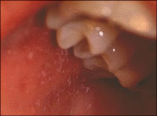 Sarampión, manchas. (lunar) de Koplik en primer plano