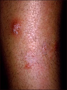 Granuloma por hongos (de Majocchi)