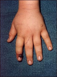 Mordida de serpiente en un dedo