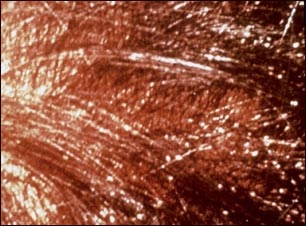 Infestación de piojos de cabeza en el cuero cabelludo