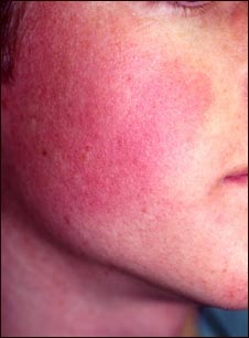 Queratosis pilaris rubra faceii