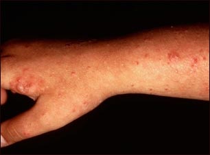 Erupci&oacute;n leve y poliforme del brazo