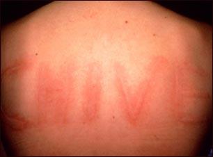 Dermatografismo de la espalda