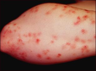 Dermatitis herpetiforme en el antebrazo