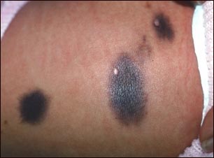 Nevo congénito en el abdomen
