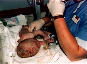 Cuidado del neonato después del parto