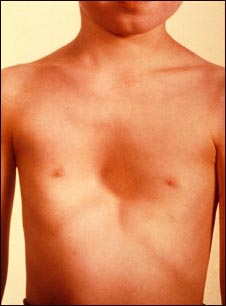 Pectus excavatum