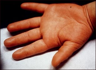 Enfermedad de Kawasaki; edema de la mano