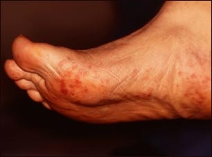 Émbolos de colesterol del Livedo reticularis en los pies
