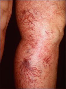 Telangiectasia en las piernas