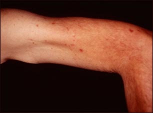 Telangiectasias en el antebrazo