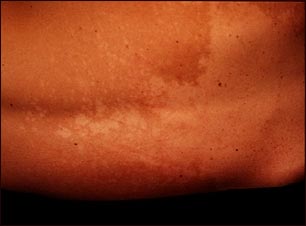 Ti&ntilde;a versicolor en la espalda