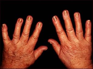 Uñas amarillas