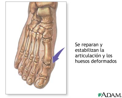 Procedimiento (segunda parte)