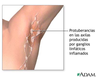 Ganglios linfáticos inflamados debajo del brazo