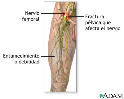 Da&#241;o al nervio femoral