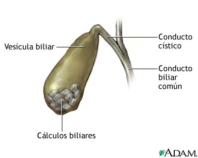 C&#225;lculos biliares