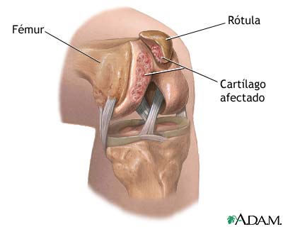 Condromalacia patelar