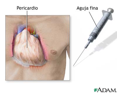 Pericardio