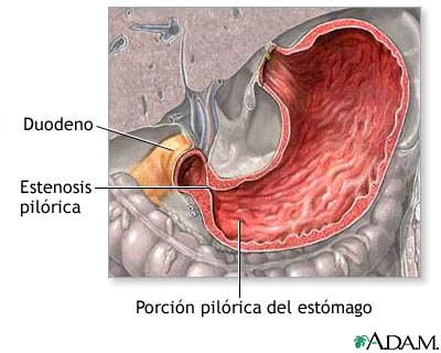 Estenosis pilórica