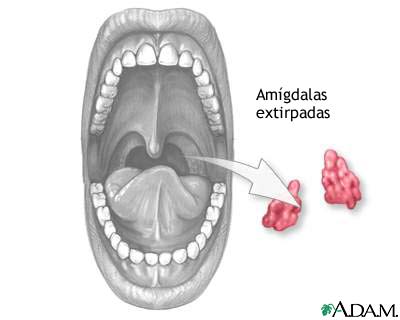 Tonsilectomía