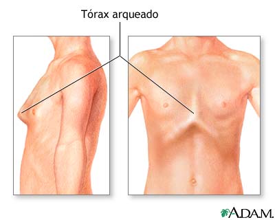 Tórax arqueado (pecho de paloma)