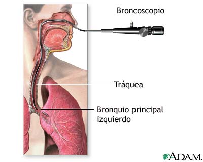 Broncoscopio