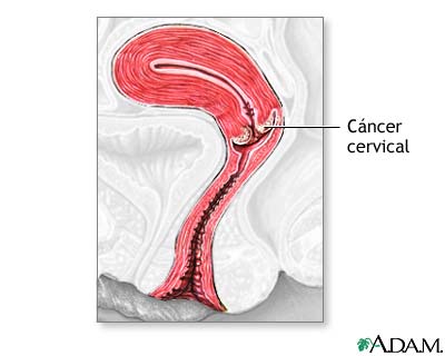 C&aacute;ncer cervical