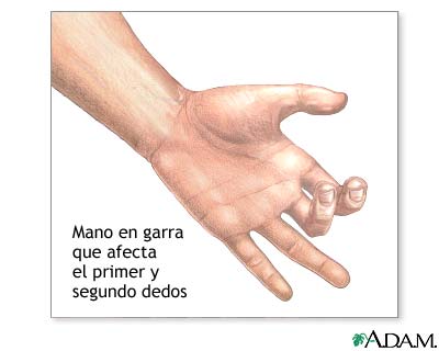 Manos en garra