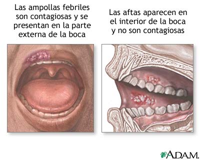 Ampollas febriles