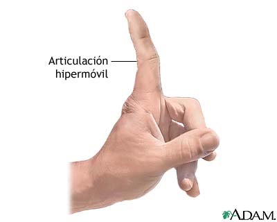 Articulaciones hiperm&oacute;viles