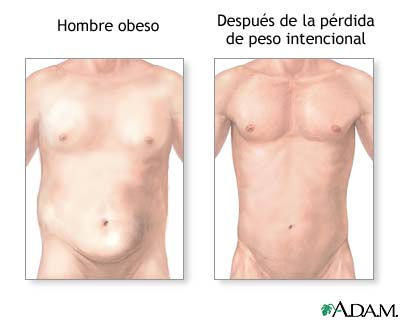 Pérdida de peso