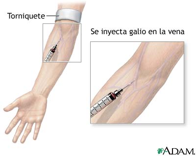 Inyecci&oacute;n de galio