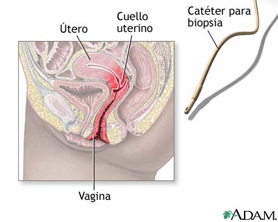 Biopsia de endometrio