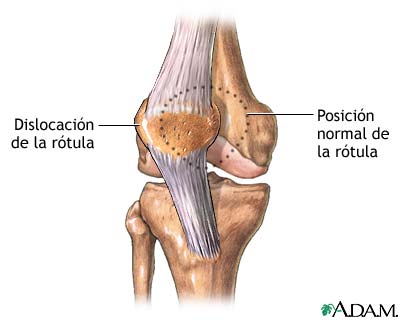 Dislocación de la rótula