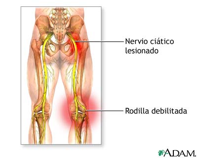 Daño al nervio ciático
