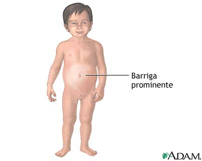 Niños barrigones