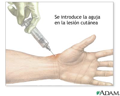 Aspiración de una lesión de piel