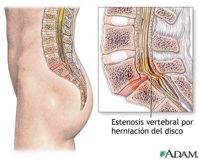 Estenosis espinal
