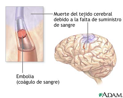 Apopleja
